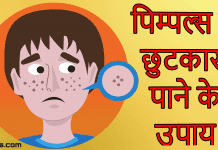 पाएं मुहांसों से छुटकारा | Ramdev Baba Remedy For Pimple Free Skin tips for pimple free skin in hindi